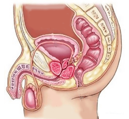 Ursaache vu Cystitis zu Männer