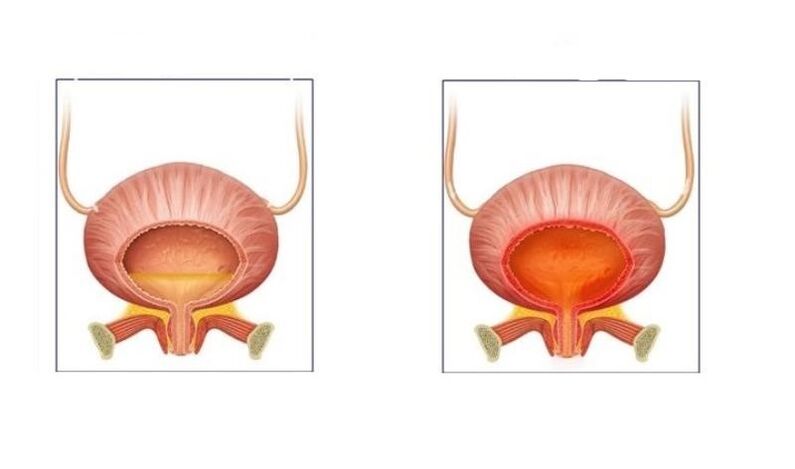Normal a Patienten mat Cystitis vum Harning Tract