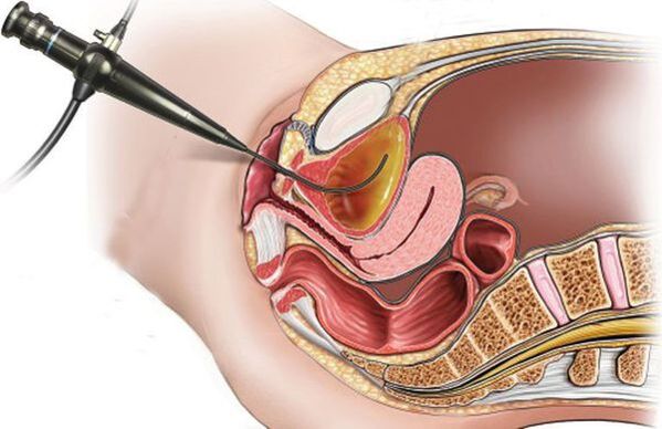 Cystoskopie fir Cystitis